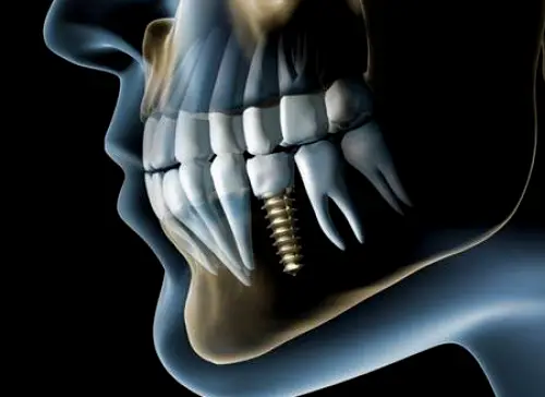 Creve Coeur Metro West Dental & Implant Institute