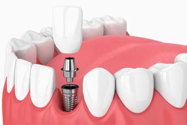 Overland Park Oakley Oral Surgery - Richard M. Oakley