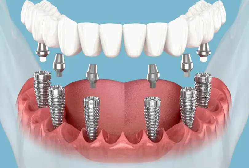 Valley Stream South Central Dental Implants