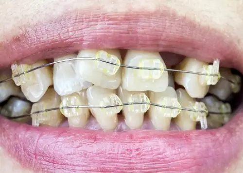 East Patchogue On Four Dental Implants