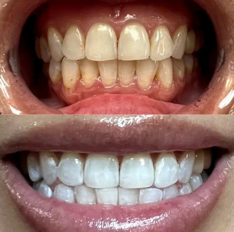 Poway Live Brightly Whitening