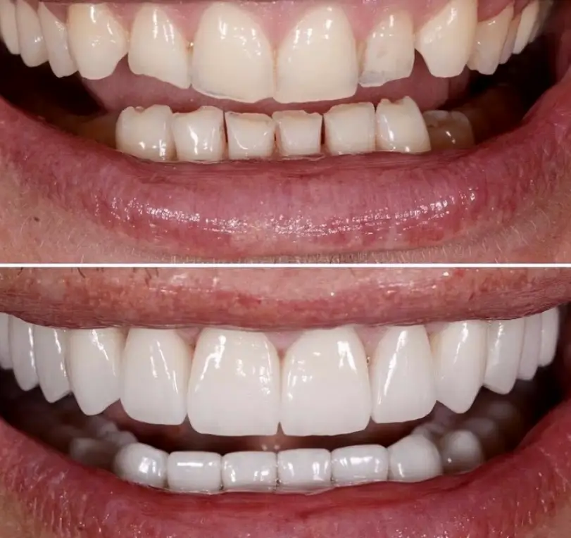 Clifton NÜVA Smile