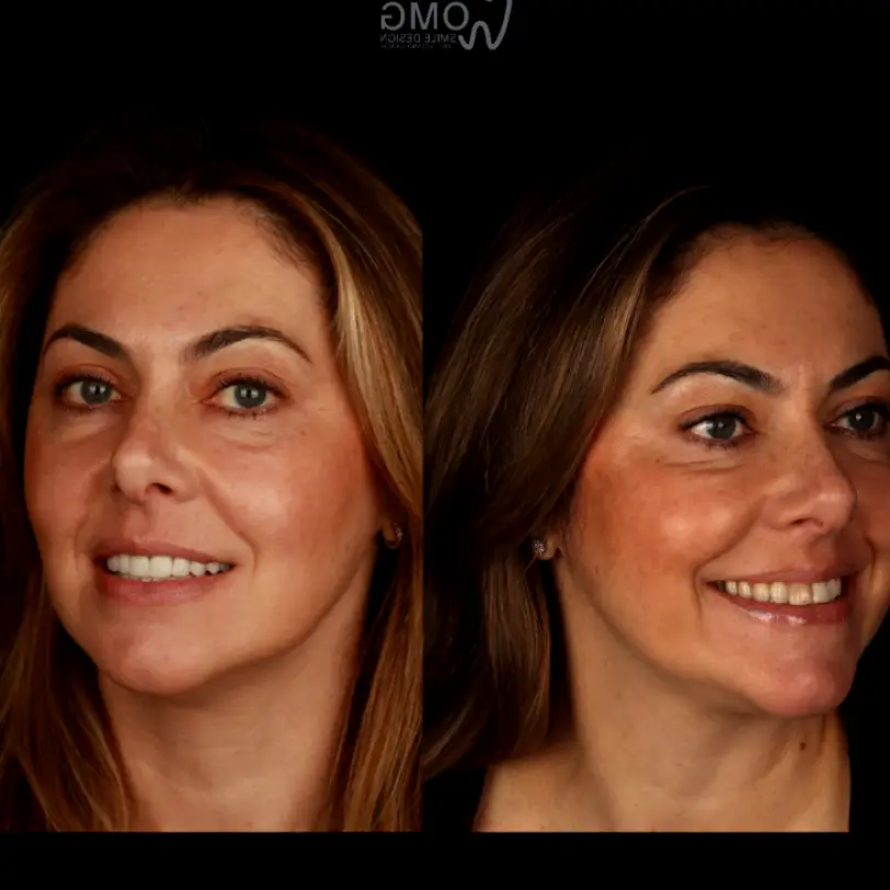  Deerfield Beach OMG Smile Design