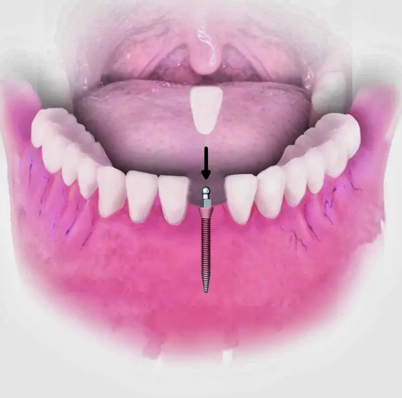  Dental Implant Solutions of The Villages FL