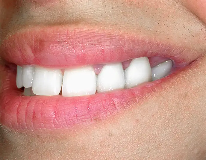 Paterson Veneers Teeth NJ