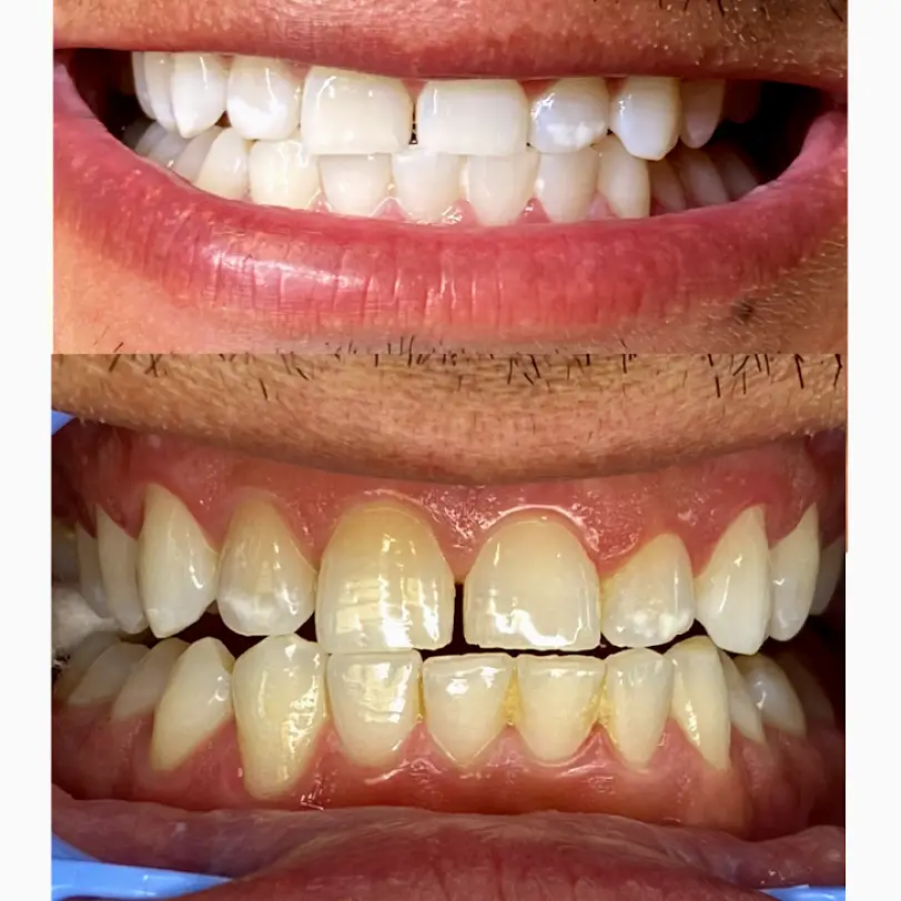 Edinburg DaVinci Teeth Whitening System RGV