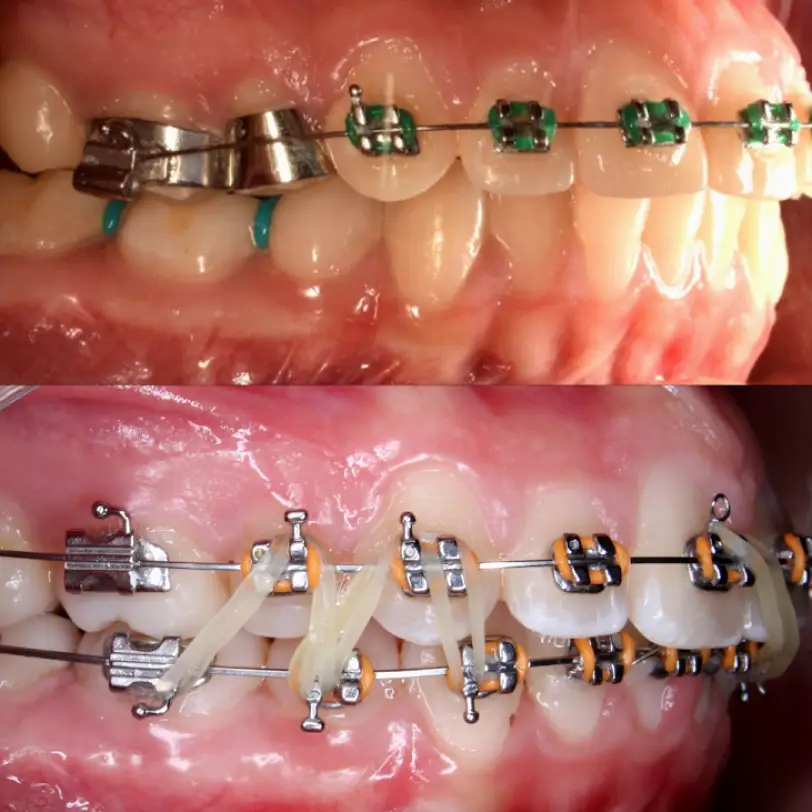 Tijuana Dental YV Orthodontics