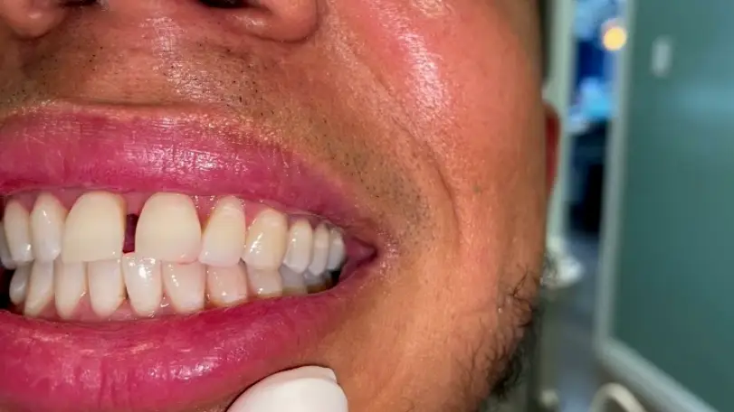 Corona Dr. Juan Peralta DDS