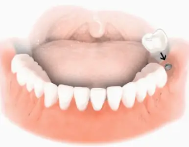 Dental Implant Solutions Plano, IL