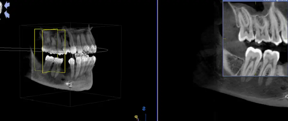 Endodontic Services - Elkhart