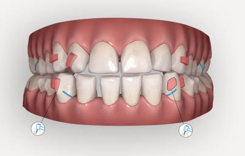 Holbrook Bracetown Orthodontics -Invisalign Center