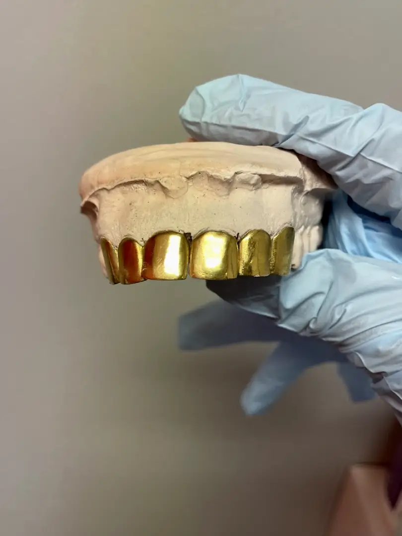 Baton Rouge Gold Teeth and Gems of LA
