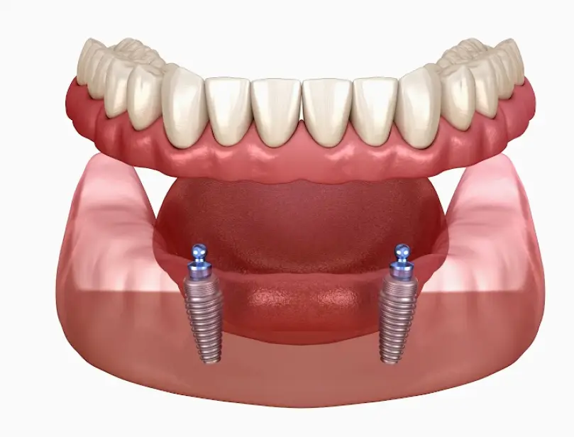  Southaven Memphis Dental Implants Center