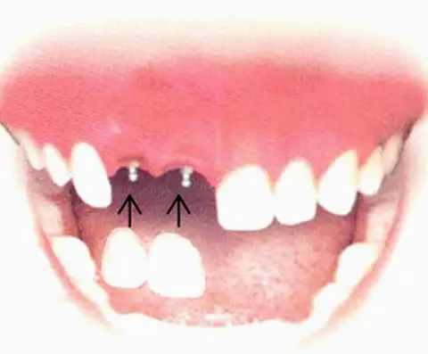 Dental Implant Solutions Parma Heights, OH
